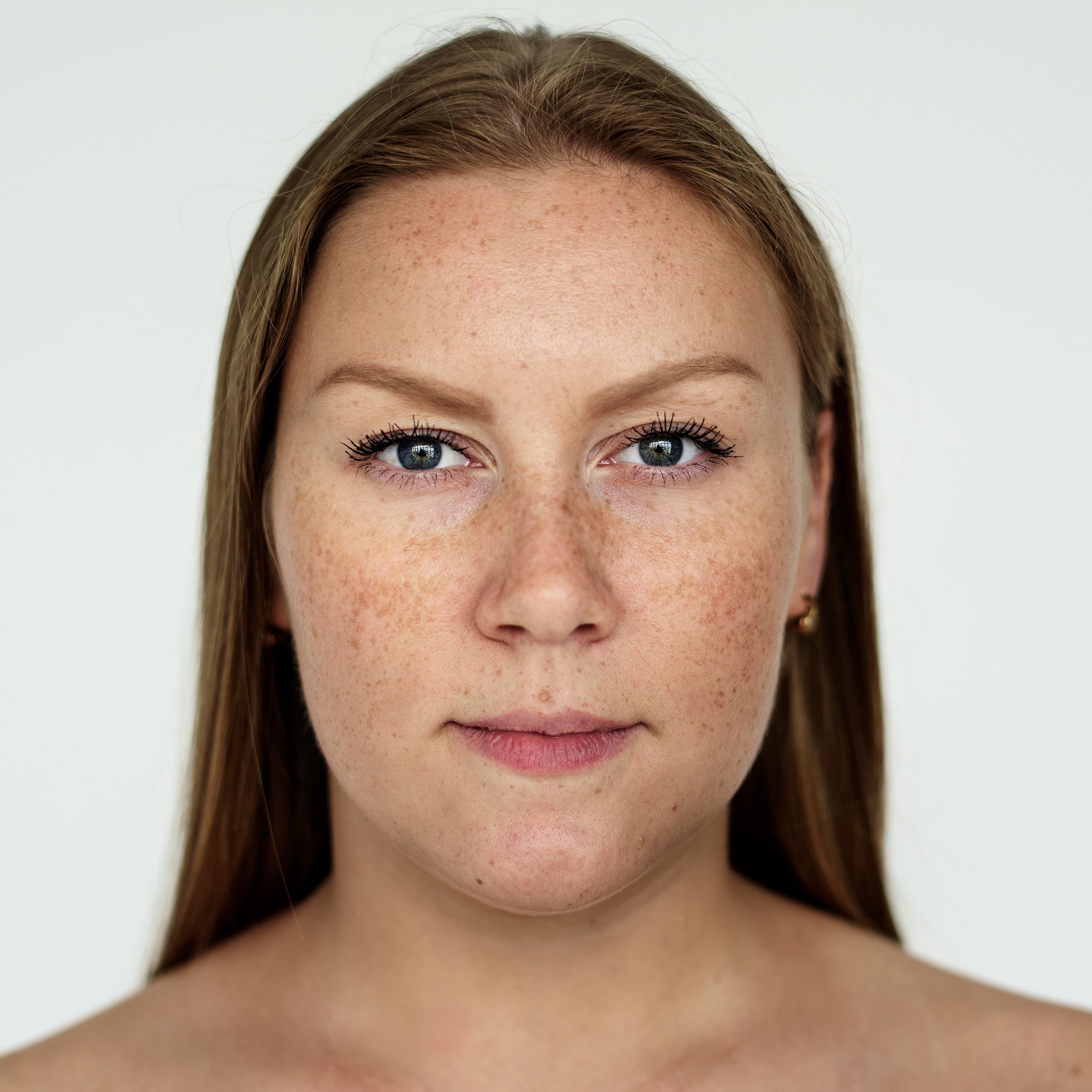 Pigmentation & Melasma