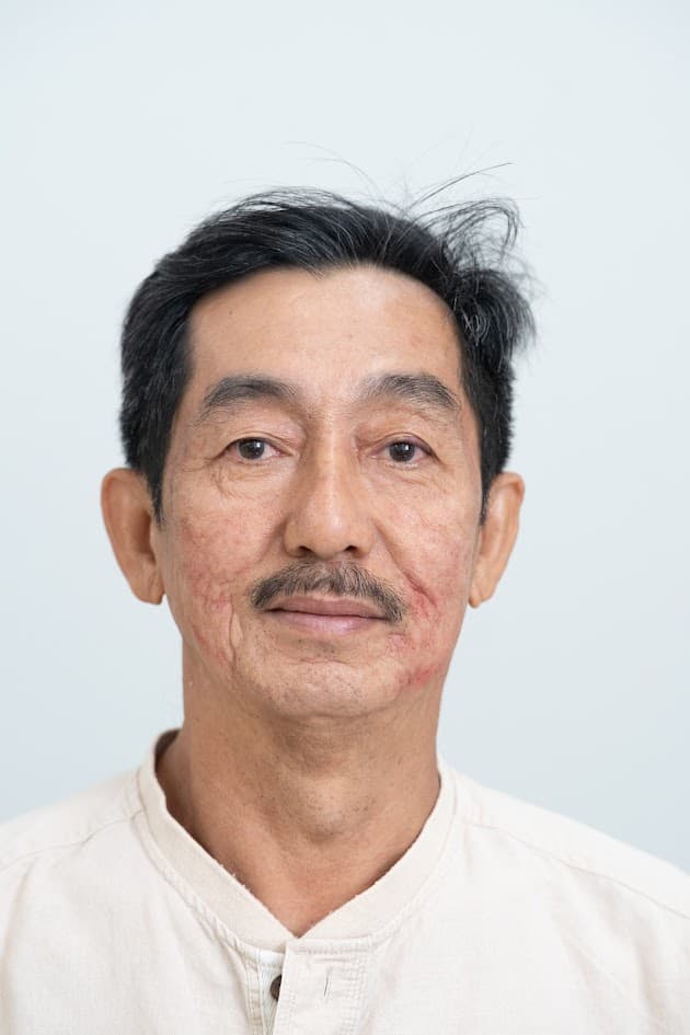 Acne Scar Treatment - Before