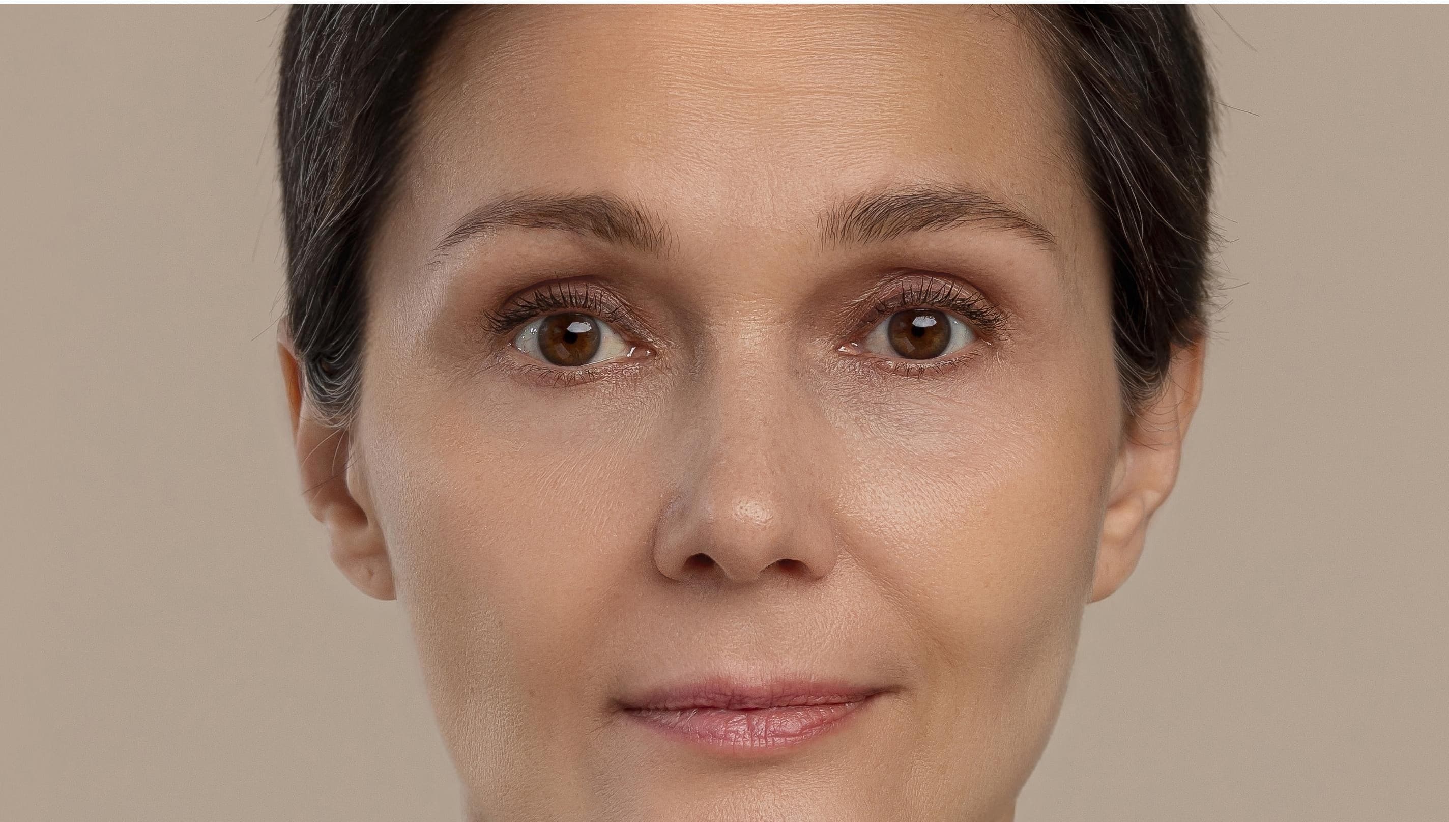 Pigmentation Removal - After