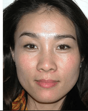 Pigmentation Removal - After