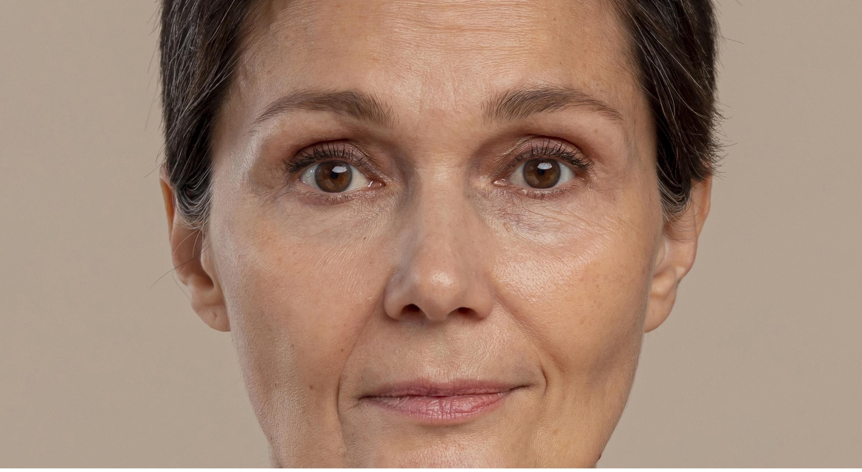 Pigmentation Removal - Before