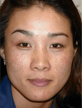 Pigmentation Removal - Before