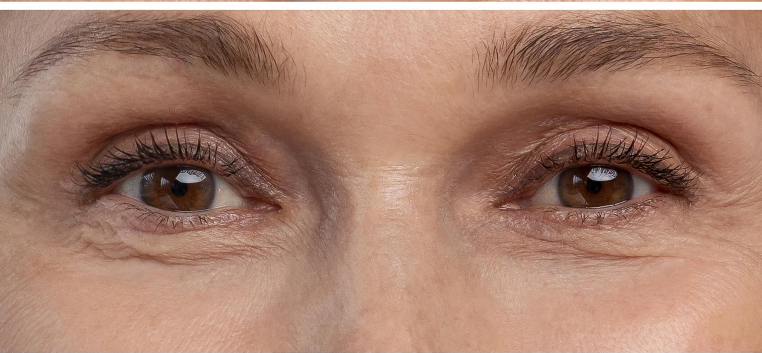 Fine Lines & Wrinkles - After